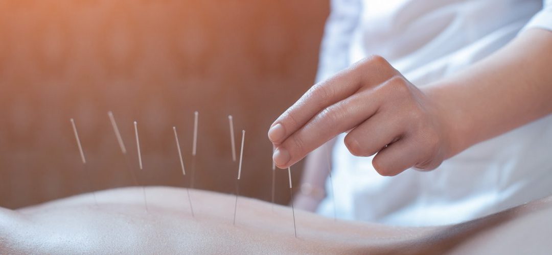 Acupuntura: essa técnica é indicada para você?